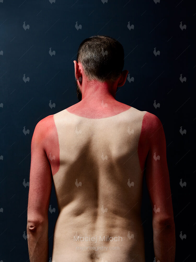 Sunburn
